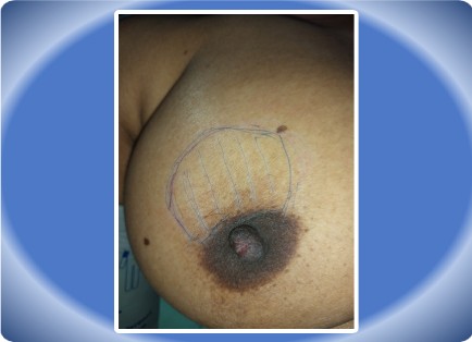 FIBROADENOMA BREAST